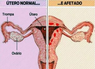 Entenda o que é adenomiose